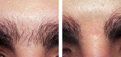 laser hair removal men brazilian